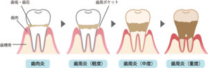 歯周病の進行症状